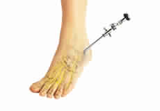 Ankle Arthroscopy