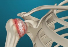 Shoulder Arthritis