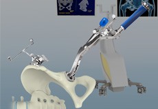 Computer Navigation for Total Hip Replacement