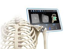 Computer Navigation for Shoulder Replacement