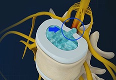 Herniated Disc