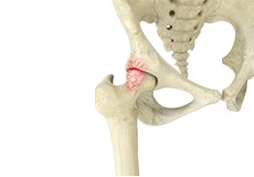 Femoro Acetabular Impingement