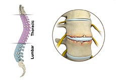 Fracture of the Thoracic and Lumbar Spine