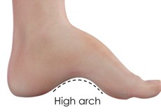 High Arch (Cavus Foot)