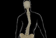 Idiopathic Scoliosis