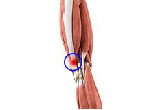 Iliotibial Band (ITB) Syndrome