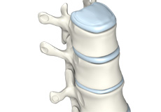 Other Congenital Vertebral Anomalies