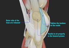 Patellofemoral Replacement