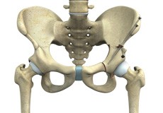 Periacetabular Osteotomy