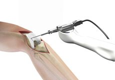 Mako Robotic Total Knee Replacement