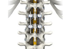 Spinal Fusion