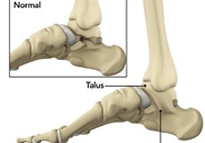 Tarsal Coalition