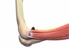 Tennis Elbow