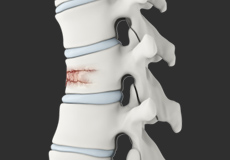 Vertebral Fractures